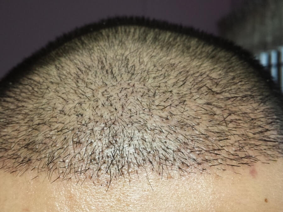 the main image - FIT vs FUT hair transplantation