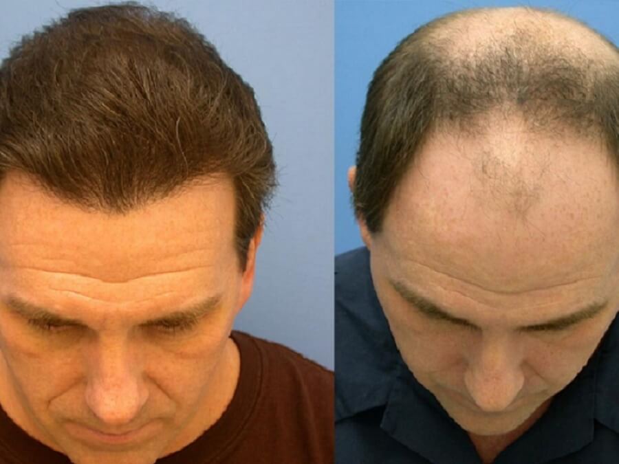 the main image - good candidate for hair restoration