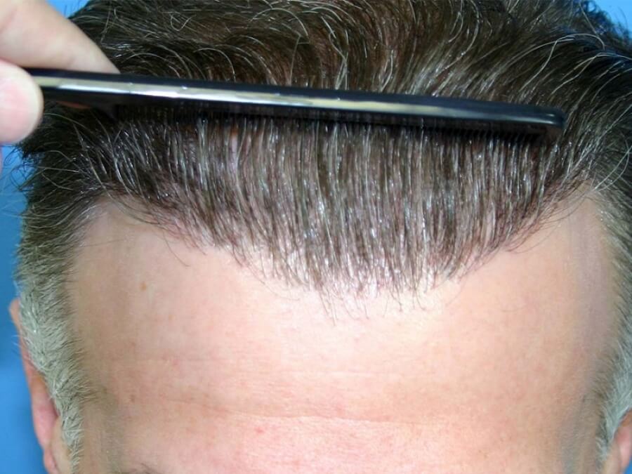 the main image - hair restoration faq
