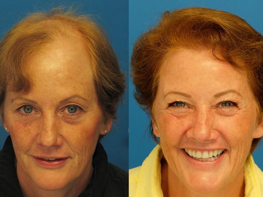 the main image - hair restoration women
