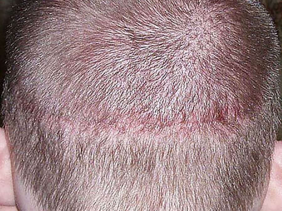 the main image - hair transplant stitches