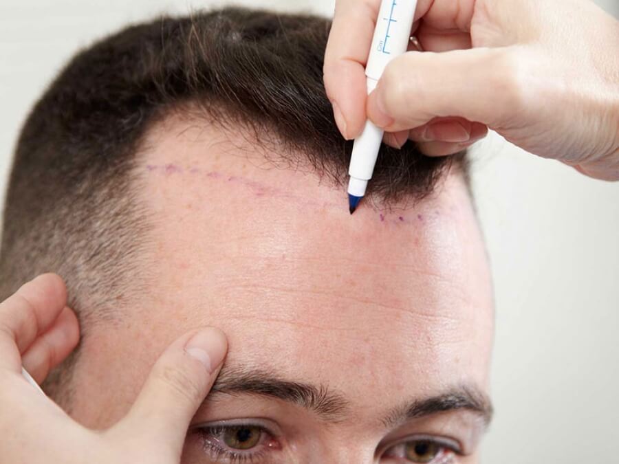 the main image - type of hair transplantation suitable for you
