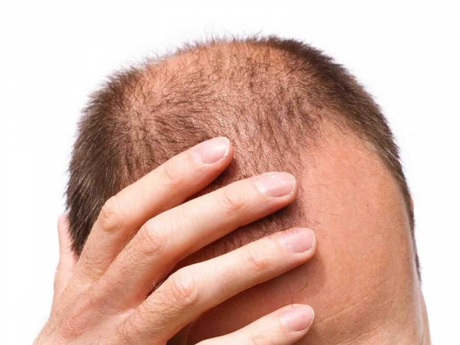 the main image - hair loss men