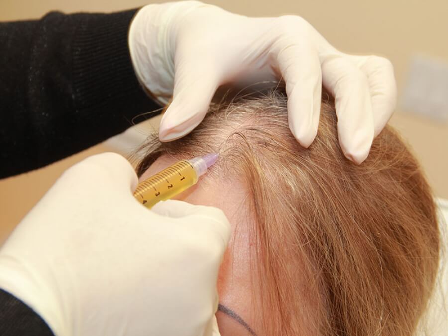 the main image - mesotherapy hair loss treatment