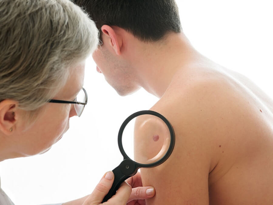 the main image - laser mole removal