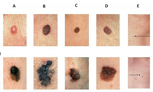 انواع مختلف خال