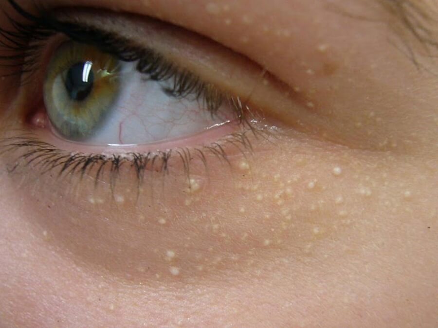 the main image - solution for subcutaneous fat