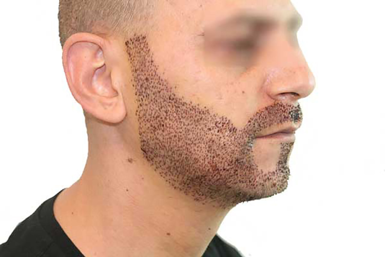 the main image - mustache restoration