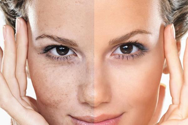 the main image - fractional co2 laser