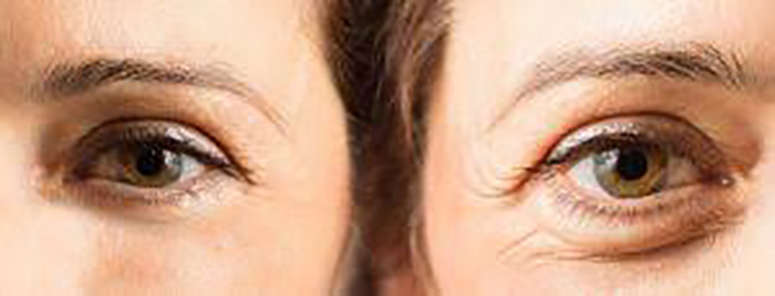 the main image - eyebrow lift