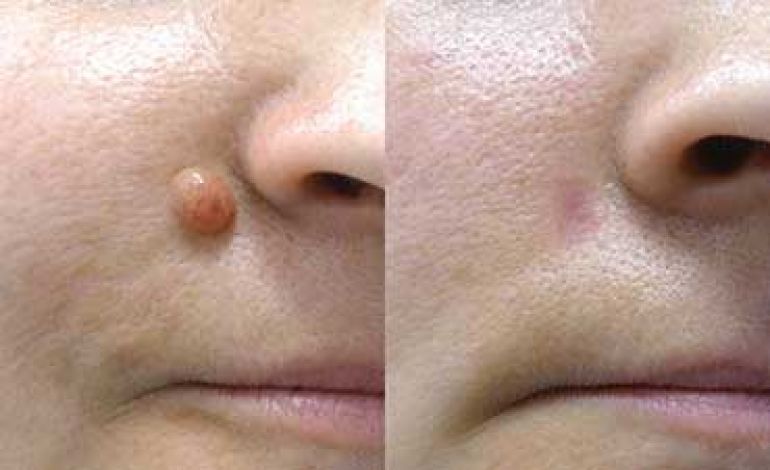 the main image - moles removal